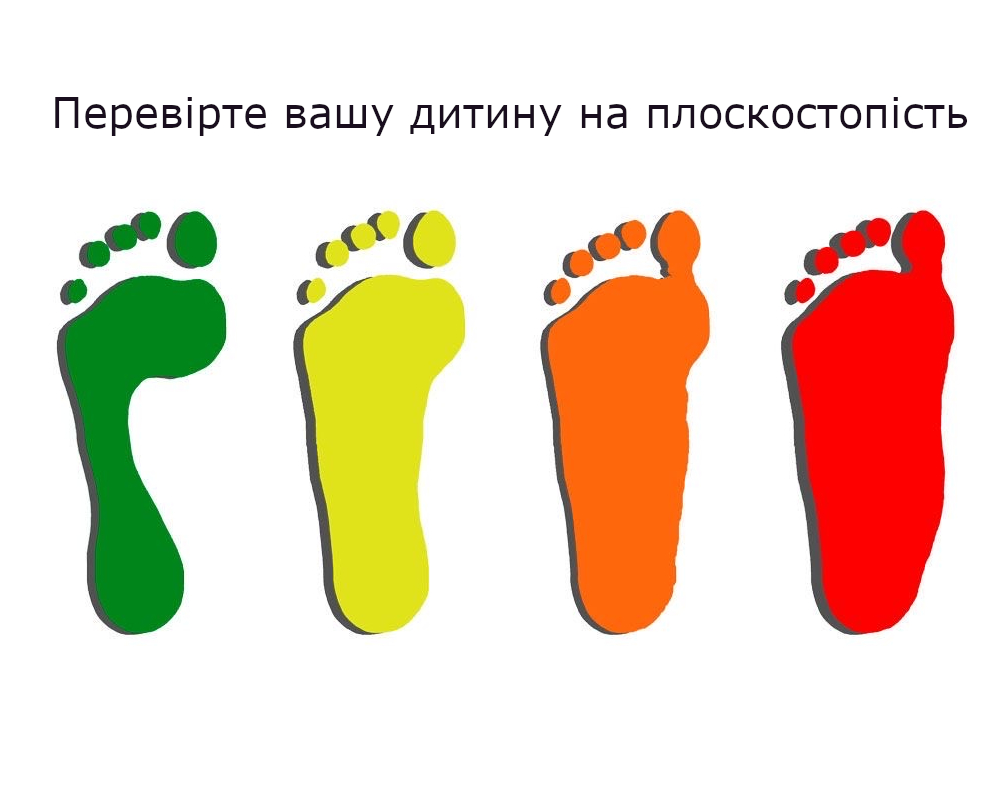Чому варто звернути увагу на плантографію - рання діагностика плоскостопості.